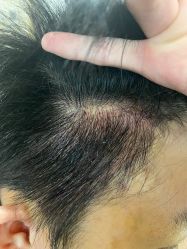 -碧莲盛·不剃发植发