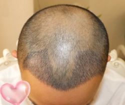 -大麦微针植发丨全国连锁