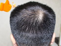 -大麦微针植发丨全国连锁