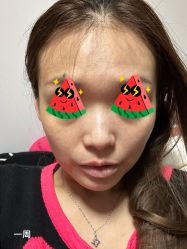 体验后-More摩尔医美の注射线雕光电中心