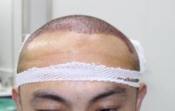 -大麦微针植发丨全国连锁