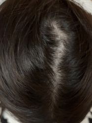 -碧莲盛·不剃发植发