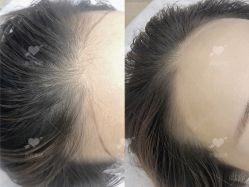 -西施无菌半永久纹绣眉眼影唇轻增发纹发际线