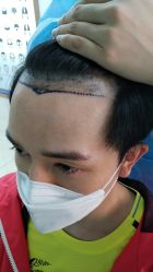 -大麦微针植发丨全国连锁