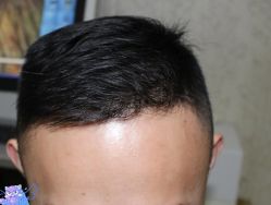 -大麦微针植发丨全国连锁