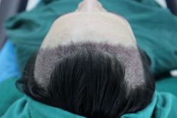 点击看大图 -大麦微针植发丨全国连锁