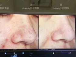 -苑苑vbeauty科技美容SPA