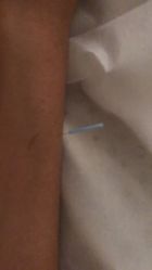 -肥三针腧穴瘦身馆