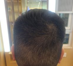 -大麦微针植发全国连锁