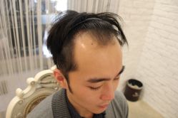 点击看大图 -大麦微针植发丨全国连锁