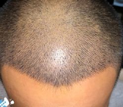 -大麦微针植发丨全国连锁