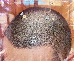 -大麦微针植发全国连锁