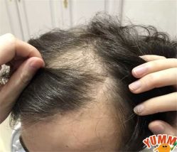 -大麦微针植发全国连锁