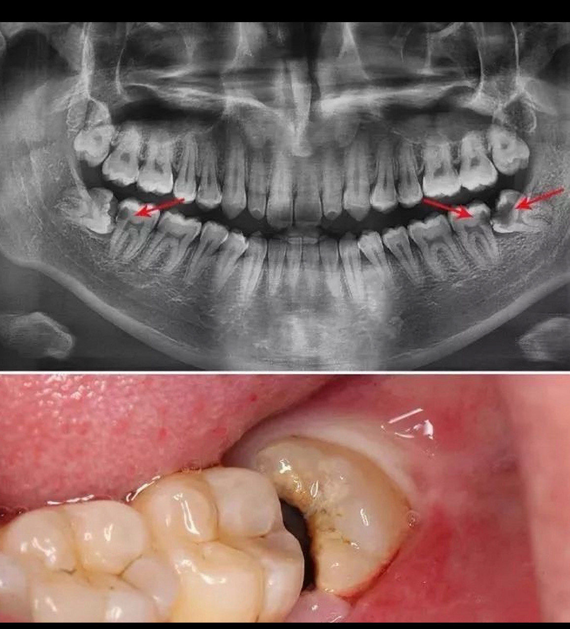 何临海医生"智齿的神"