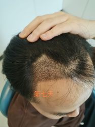 体验后-大麦微针植发全国连锁