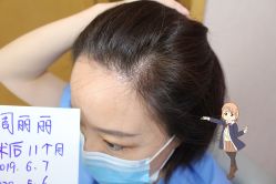 -大麦微针植发丨全国连锁