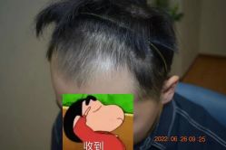 体验前-大麦微针植发全国连锁