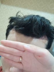 -新生植发·植养护一体