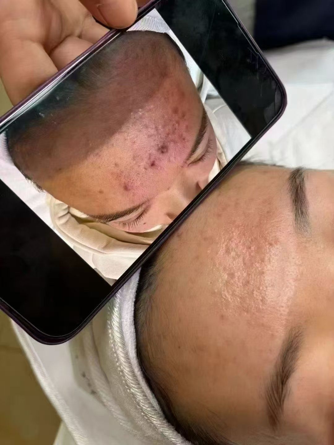 毛囊堵成这样了
