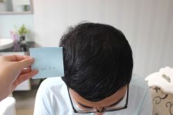 -大麦微针植发丨全国连锁