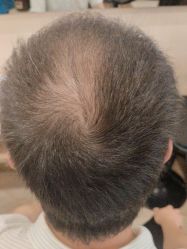 -碧莲盛·不剃发植发