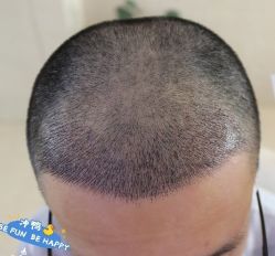 -大麦微针植发丨全国连锁