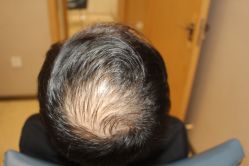 -大麦微针植发丨全国连锁