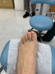 -派恩宜灰指甲鸡眼嵌甲手足癣