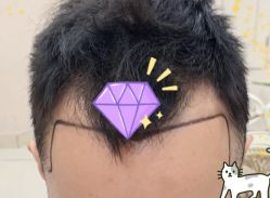 -大麦微针植发全国连锁