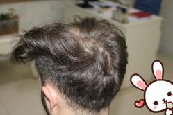 点击看大图 -大麦微针植发丨全国连锁