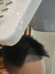 -碧莲盛·不剃发植发