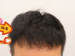 -大麦微针植发全国连锁