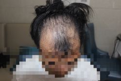 -大麦微针植发全国连锁