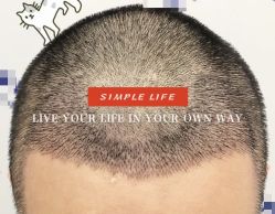 -大麦微针植发全国连锁