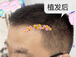 -大麦微针植发全国连锁