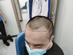 -大麦微针植发全国连锁