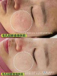 -凡碧诗毛孔清洁收细