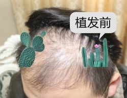 -大麦微针植发全国连锁