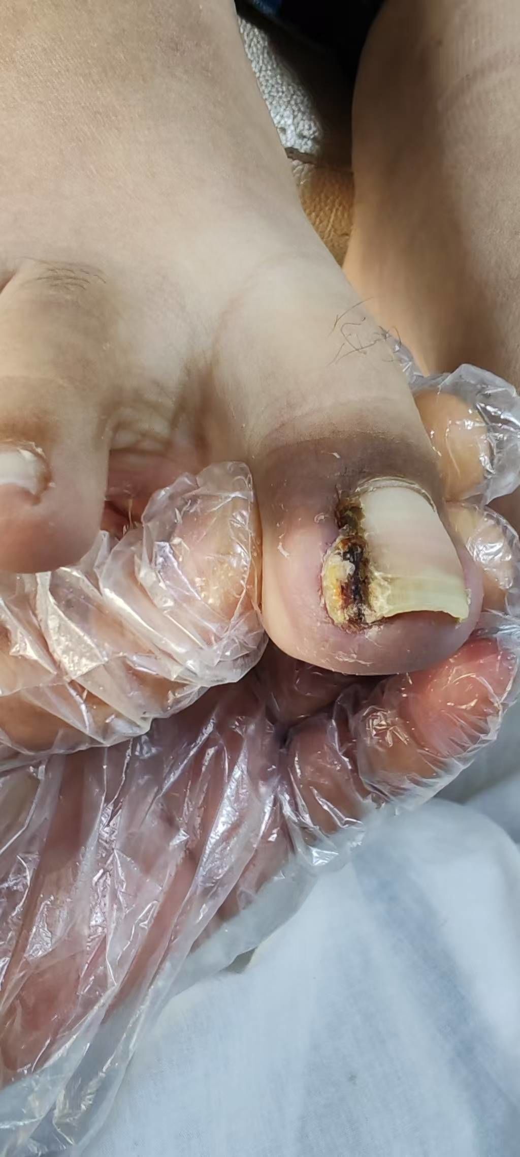 这家店真的太值得认可和推荐了,年前我的甲沟炎特别严重,都长肉芽了