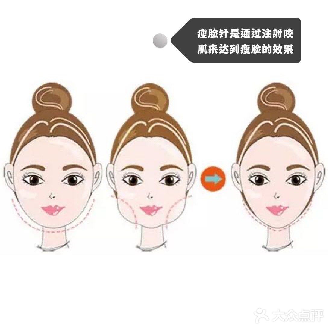 瘦脸针和除皱针都是肉毒素，二者的区别是什么？