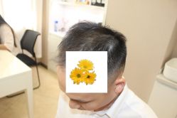 -大麦微针植发丨全国连锁