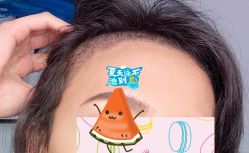 -大麦微针植发全国连锁