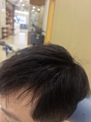 -大麦微针植发全国连锁