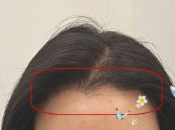 -大麦微针植发全国连锁