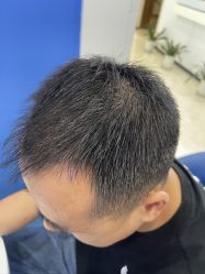 体验后-大麦微针植发全国连锁