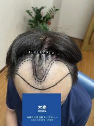 体验前-大麦微针植发全国连锁