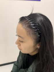 -大麦微针植发全国连锁