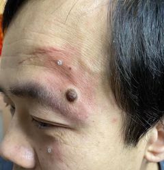 -北京美痣堂古方祛痣斑疣瘊