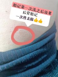-净肤洗纹身
