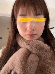 体验前-大华韩艺整形美容医院